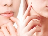Tẩy Xóa Nốt Ruồi